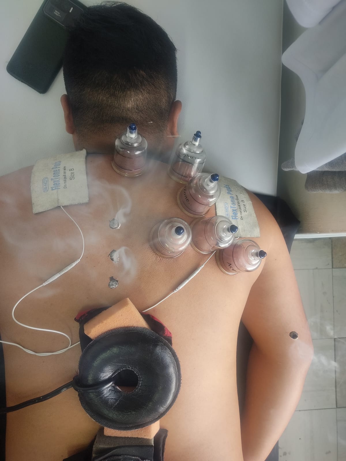Paciente recibiendo terapia con ventosas y electroestimulación en la espalda